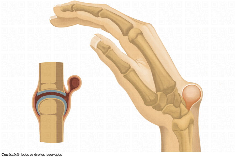 boli articulare sinoviale leziunea articulației falangelui degetelor