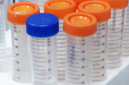 Azoospermia: conceito, causas, sintomas, diagn&oacute;stico, tratamento, evolu&ccedil;&atilde;o