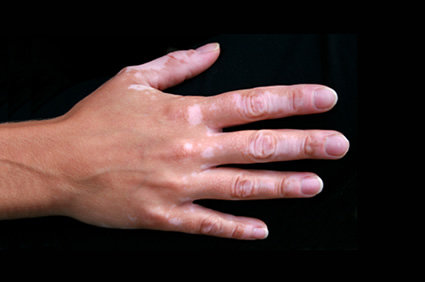O que é vitiligo?