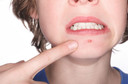 Acne: como melhorar o aspecto da sua pele?