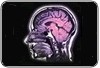 Acidente Vascular Cerebral ou Derrame Cerebral