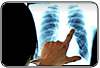 Pneumonia em adultos. Parte I.