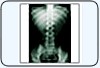 Osteoporose. O que �?