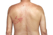 Neuralgia pós-herpética: por que a dor do herpes-zóster pode persistir por meses ou anos?