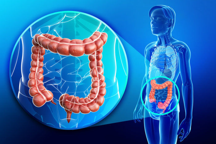Pancolite - O que é? Como fazer o diagnóstico e o tratamento? Tem prevenção?