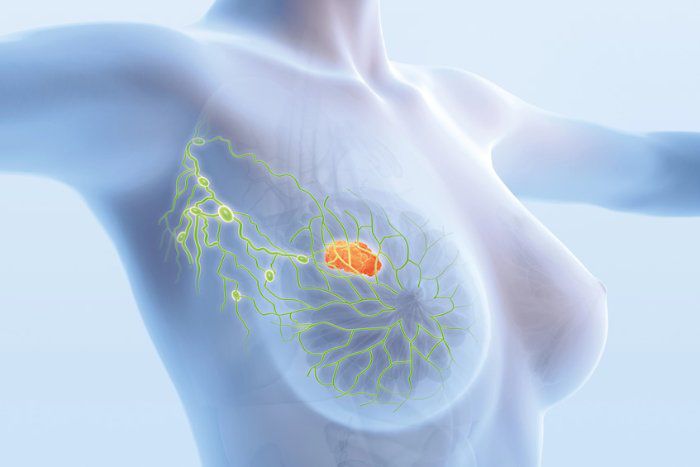 Mastectomia: entenda a cirurgia, a reconstrução e os cuidados após o procedimento