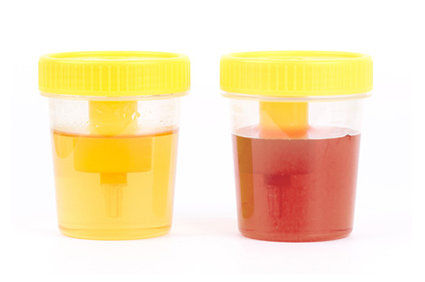 As cores da urina e suas rela&ccedil;&otilde;es com doen&ccedil;as e medicamentos