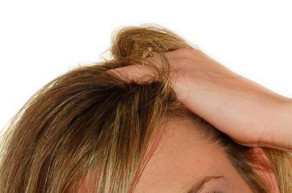 Caspas: o que são? Quais as causas, tratamento, prevenção e evolução?