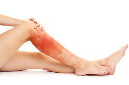 Celulite infecciosa - como ela &eacute;? O que deve ser feito para evit&aacute;-la?