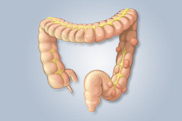 Diverticulose: defini&ccedil;&atilde;o, causas, sinais e sintomas, diagn&oacute;stico, tratamento, evolu&ccedil;&atilde;o e complica&ccedil;&otilde;es
