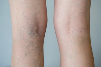 Doenças das veias