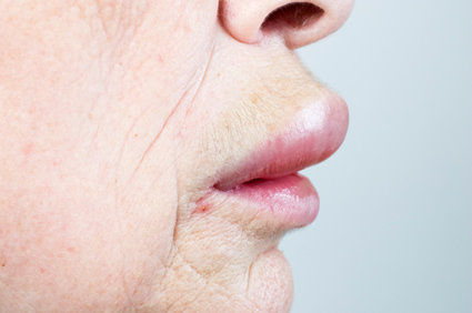 Edema de Quincke: o que é isso?