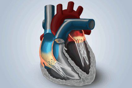 Estenose mitral: o que &eacute;? Quais as causas? E os sintomas? Como s&atilde;o o diagn&oacute;stico e o tratamento? Como &eacute; a evolu&ccedil;&atilde;o? Existe preven&ccedil;&atilde;o?