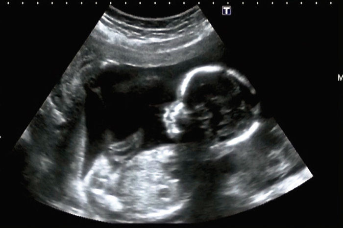 Fatores de restrição ao crescimento intrauterino