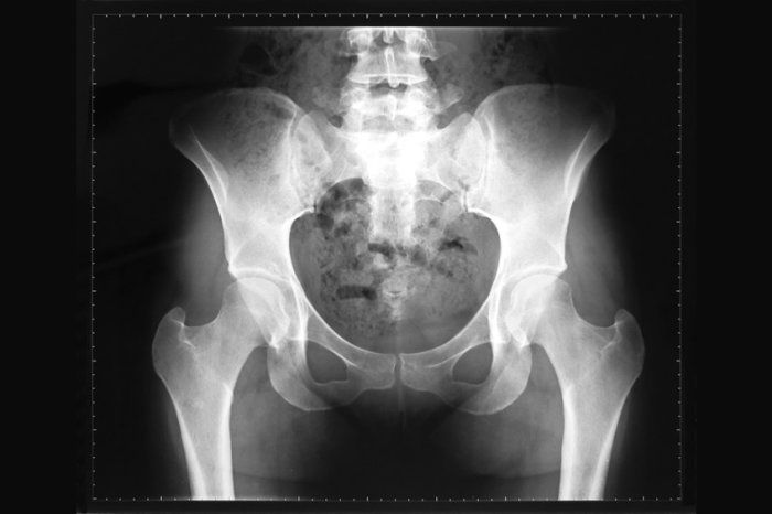Fragilidade óssea inexplicada? Pode ser displasia fibrosa