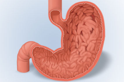 Gastrite enantematosa - como ela &eacute;?