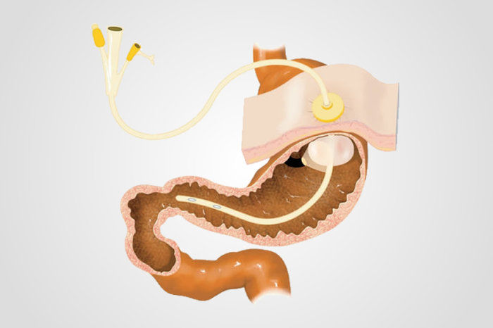 Gastrostomia - como é o procedimento? Quando deve ser feita?