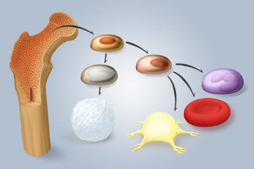 Leucemia mieloide crônica
