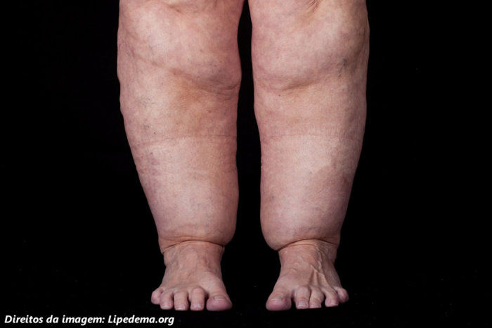 Lipedema - caracter&iacute;sticas, diagn&oacute;stico e o que fazer