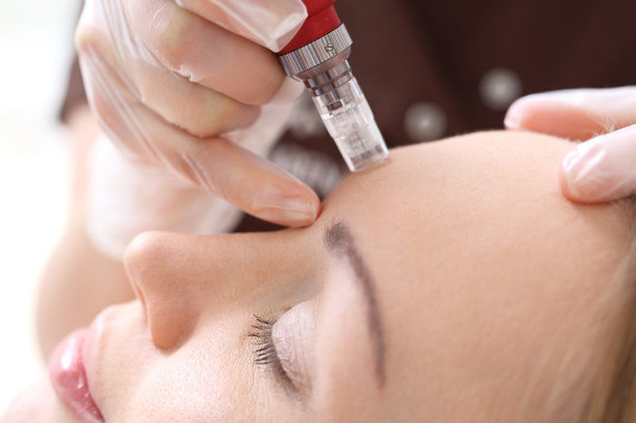 Microagulhamento no tratamento dermatol&oacute;gico