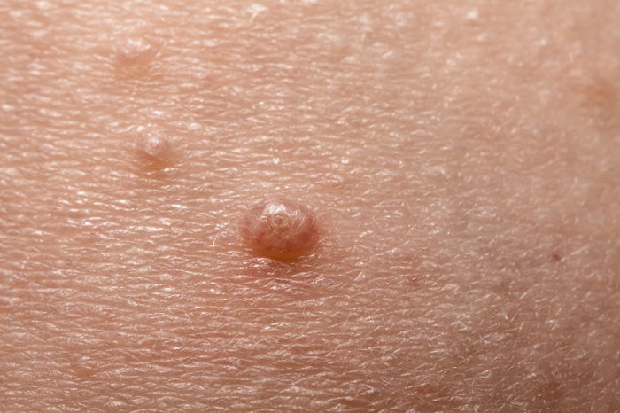 Molusco contagioso - conheça essa infecção de pele