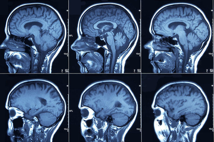 O glioma e as suas características