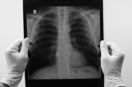 Pneumot&oacute;rax: voc&ecirc; sabe o que &eacute; e como ele acontece?