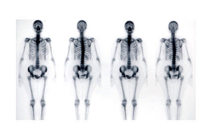 Saiba mais sobre a cintilografia óssea: para que serve, quais os riscos do exame, como é feito?