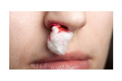 Sangramento nasal ou epistaxe: quais s&atilde;o as causas? O que se deve fazer? O que n&atilde;o fazer quando o nariz sangra? E ap&oacute;s o sangramento?