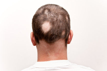 Voc&ecirc; sabe o que &eacute; alopecia areata?