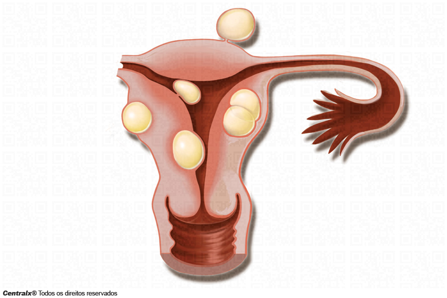 Cisto de útero
