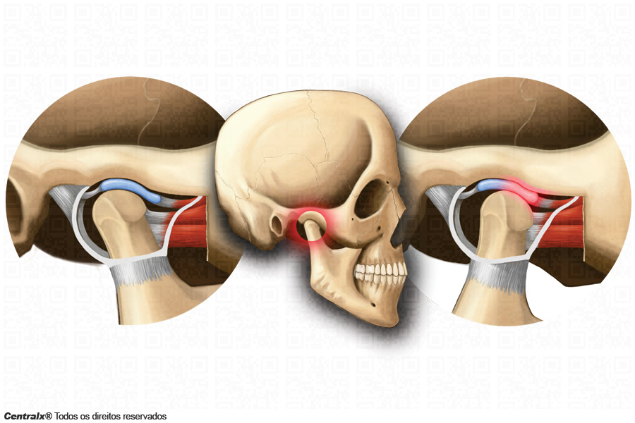 Meu queixo caiu! O que é a luxação da mandíbula? - Ortopedia e