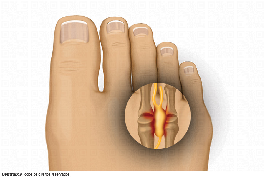 Neuroma de Morton