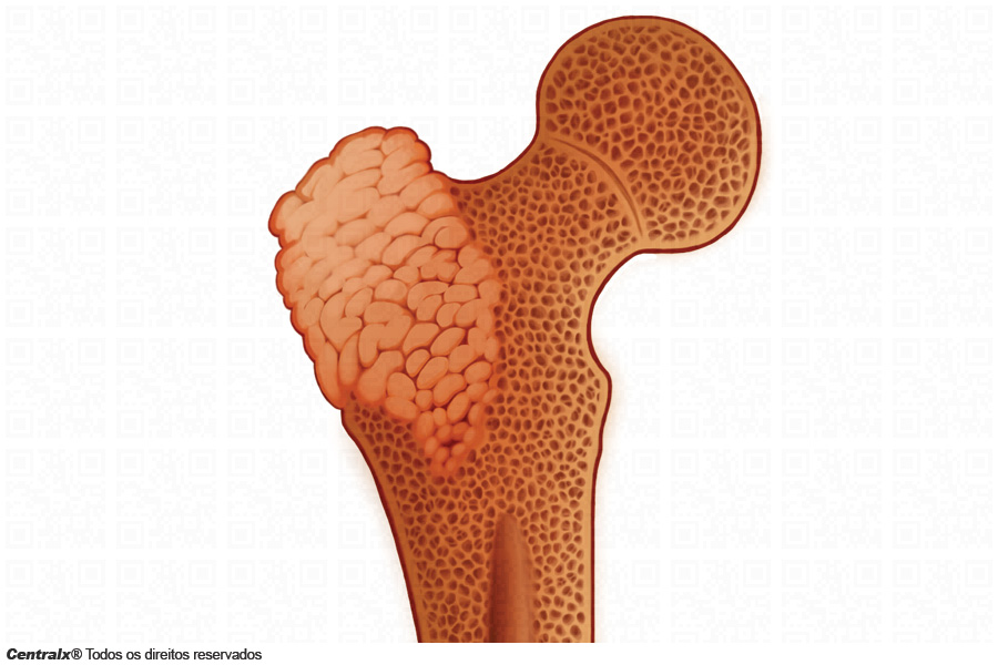 Osteossarcoma