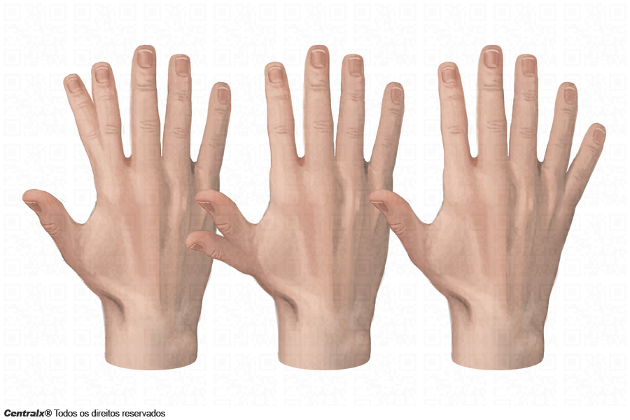 Polidactilia Polidactilia