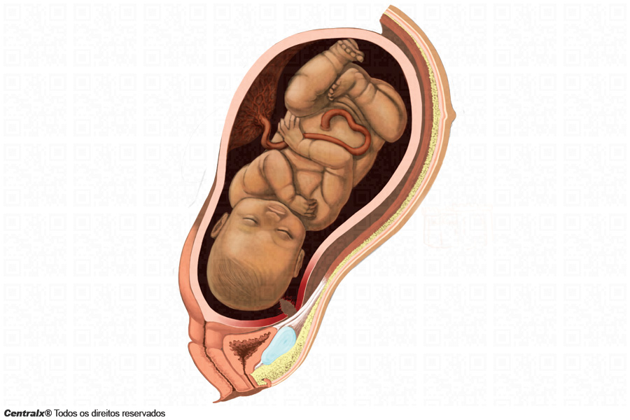 Ruptura uterina