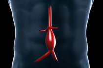 Aneurismas arteriais viscerais são raros, silenciosos e perigosos: saiba como identificá-los e tratá-los!