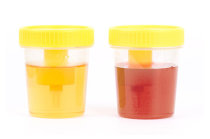 As cores da urina e suas relações com doenças e medicamentos