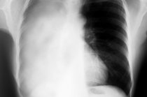 Atelectasia pulmonar: o que é isso?