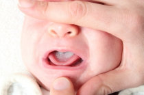 Candidíase oral do bebê: seu filho já teve “sapinho”?