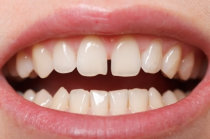 Dentes separados - você pode ter diastema!