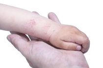 Eczema - conceito, sintomas, formas, diagnóstico, tratamento e prevenção