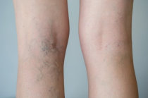 Pernas com manchas amarronzadas? Pode ser dermatite ocre!