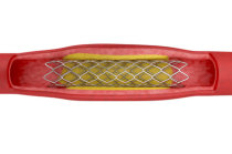 Stent - O que é? Quem deve colocar? Como é o procedimento? Quais as possíveis complicações?