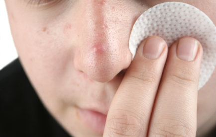 Acne: como melhorar o aspecto da sua pele?
