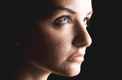Acne na mulher adulta