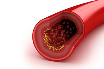 Arterioesclerose: como ela &eacute;? O que acontece no nosso organismo? Como prevenir?