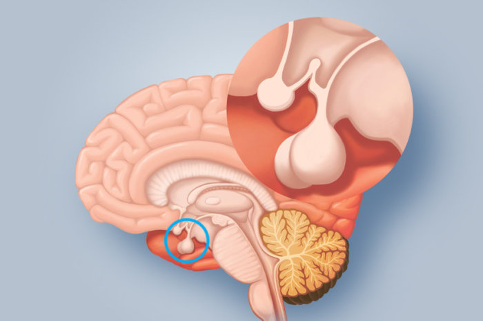 Cisto da Fenda de Rathke