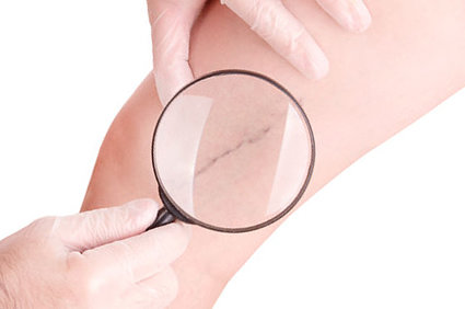 escleroterapia por injeção para malformação venosa