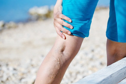 Flebite: conceito, causas, sintomas, diagnóstico, tratamento, prevenção ...